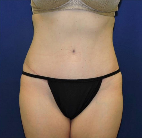 Abdominoplasty