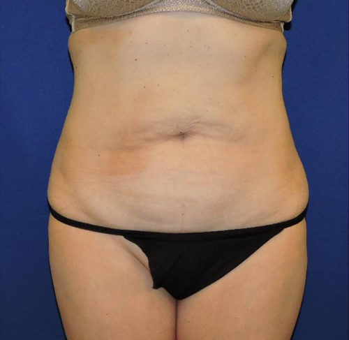 Abdominoplasty