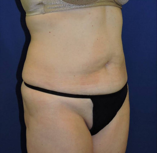 Abdominoplasty