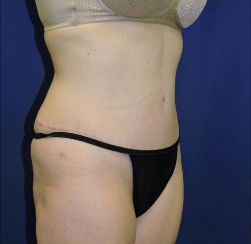 Abdominoplasty