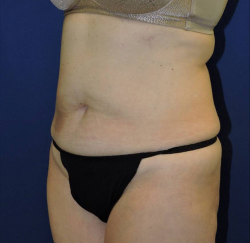 Abdominoplasty