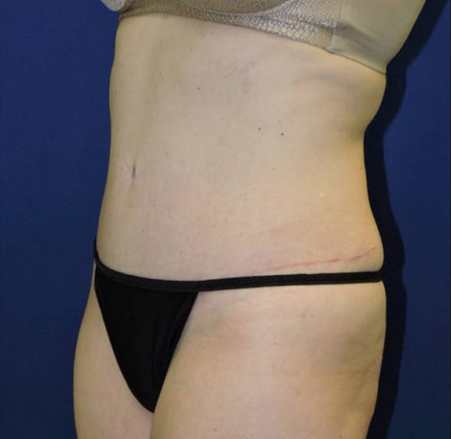 Abdominoplasty