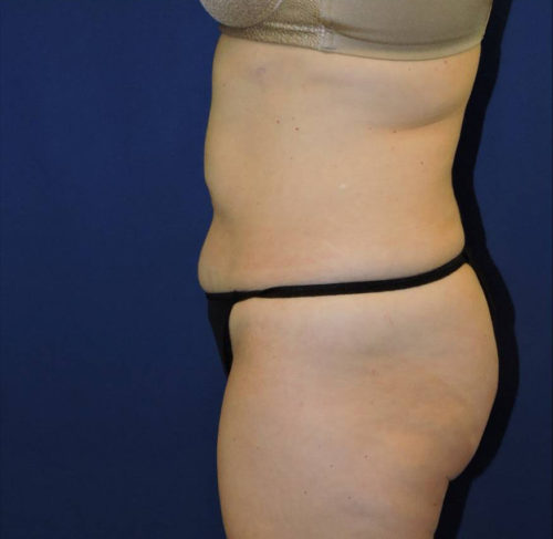 Abdominoplasty