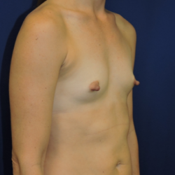 Breast Augmentation