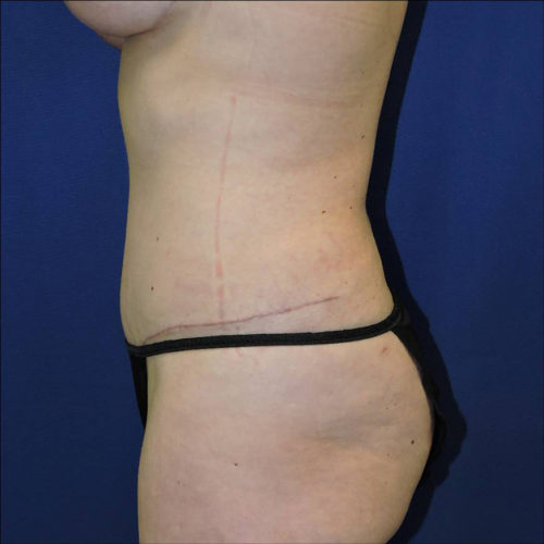 Abdominoplasty