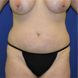 Abdominoplasty