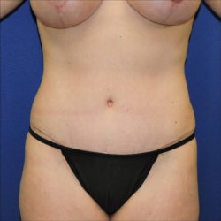 Abdominoplasty