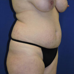 Abdominoplasty