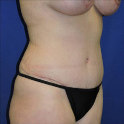 Abdominoplasty