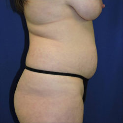 Abdominoplasty