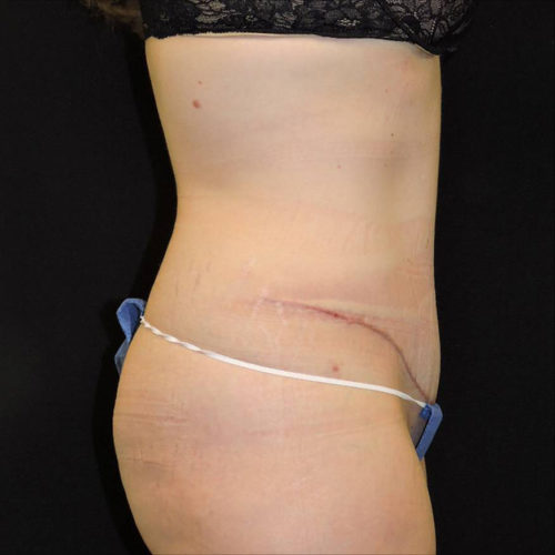 Abdominoplasty