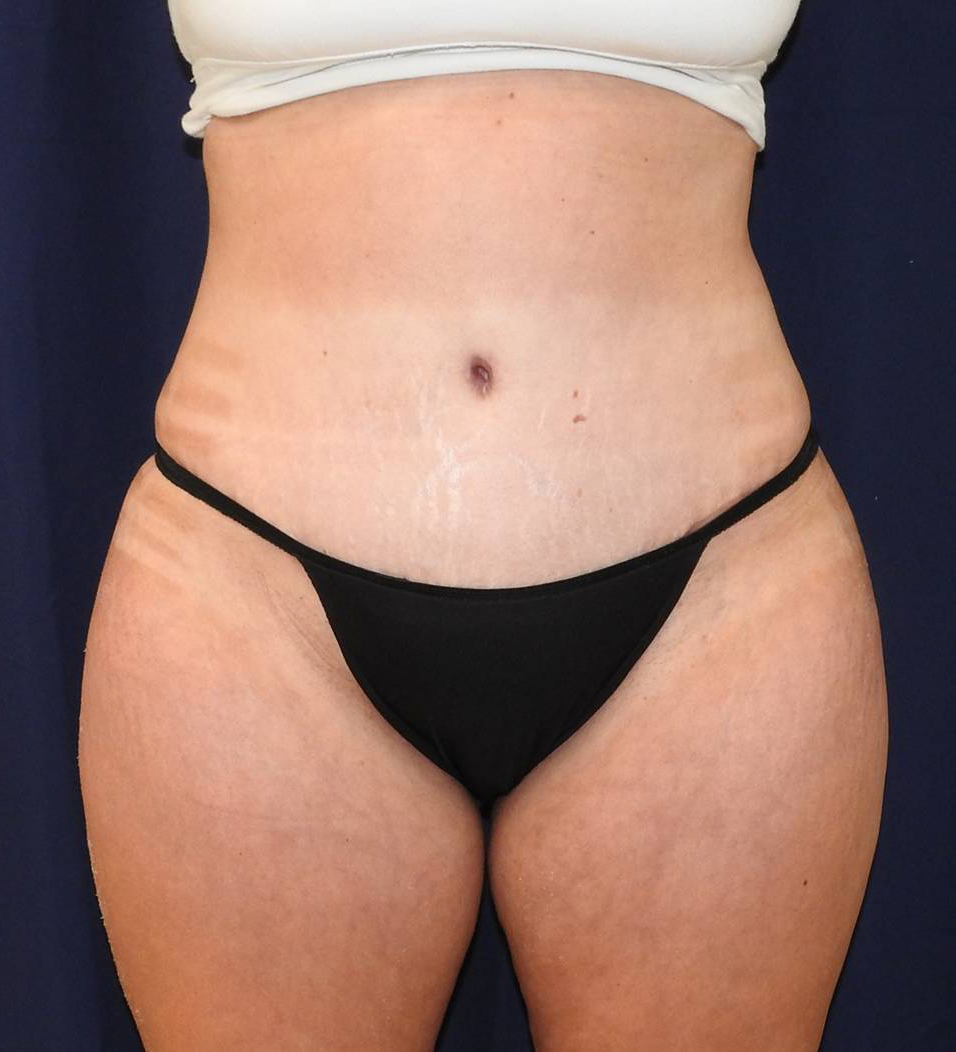 Abdominoplasty Before & After Photos