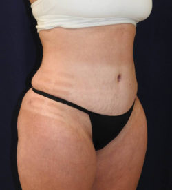 Abdominoplasty