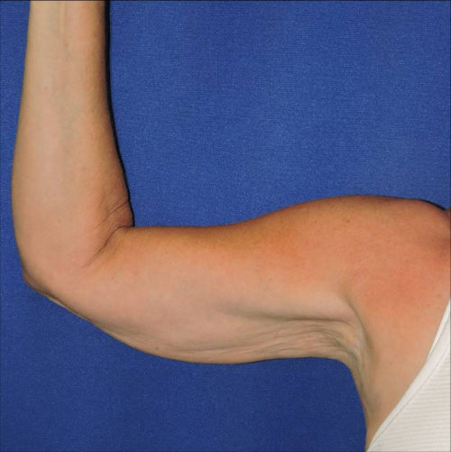 Arm Lift