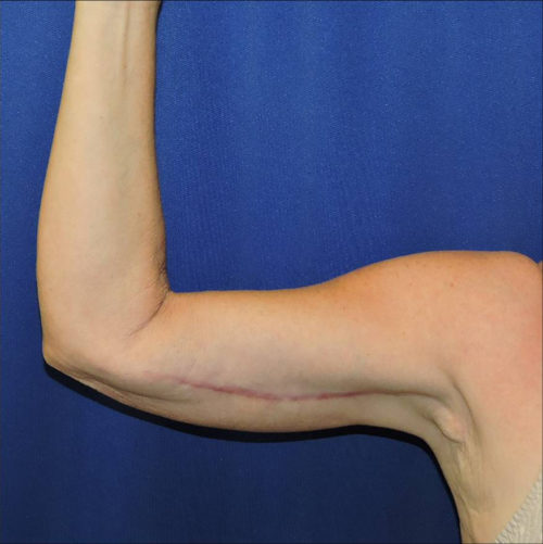 Arm Lift