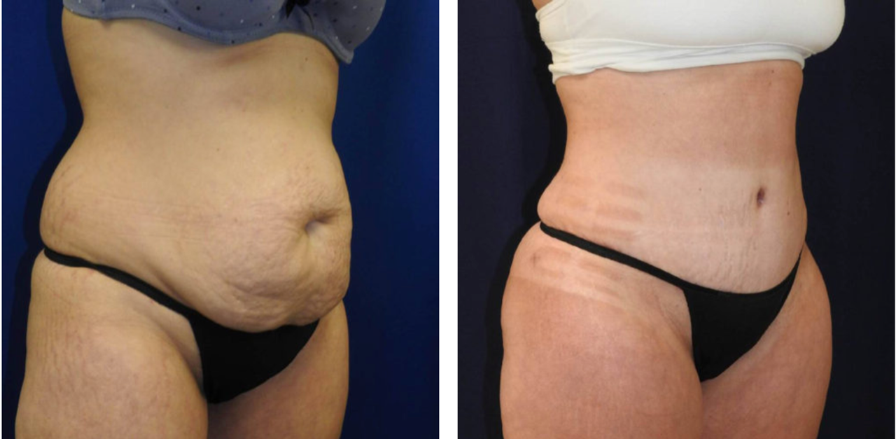 Abdominoplasty Before & After Results