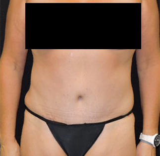 Abdominoplasty Before & After Results