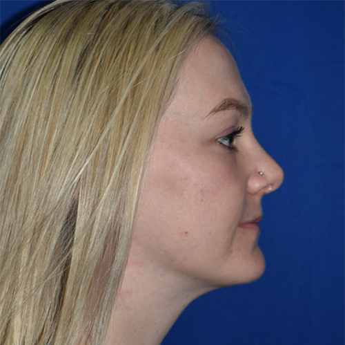 Rhinoplasty