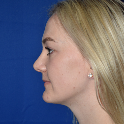 Rhinoplasty