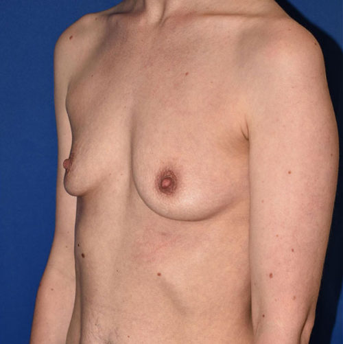 Breast Augmentation