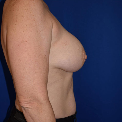 Breast Augmentation