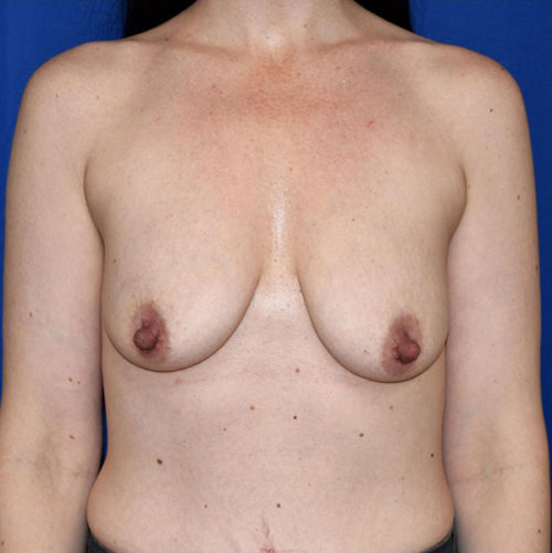 Breast Augmentation With Lift