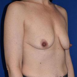 Breast Augmentation With Lift