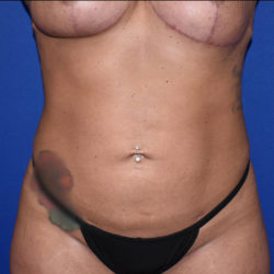 Liposuction