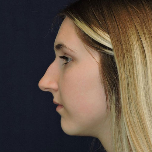 Rhinoplasty