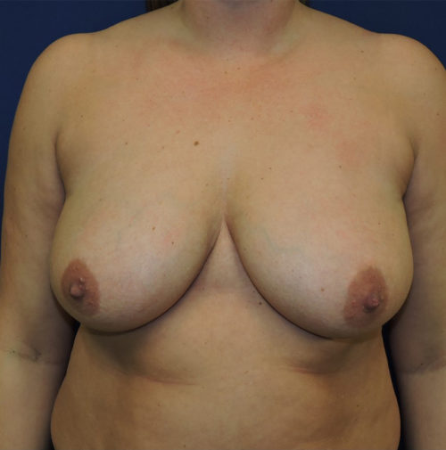 Breast Augmentation With Lift
