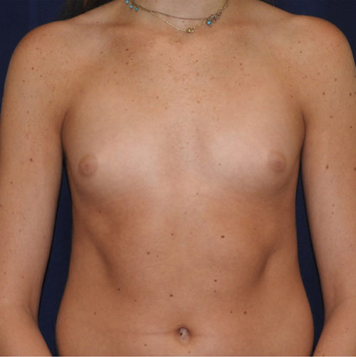 Breast Augmentation