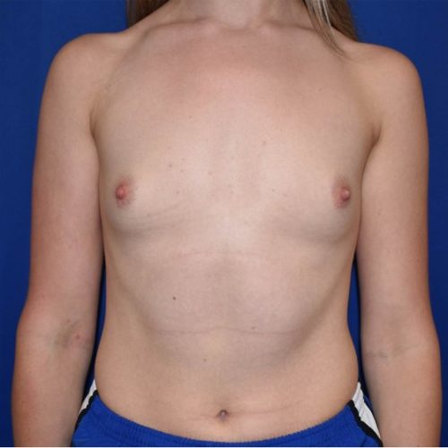 Breast Augmentation