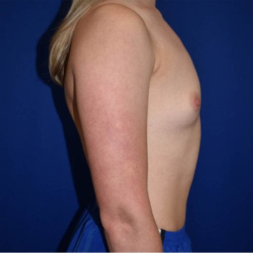 Breast Augmentation