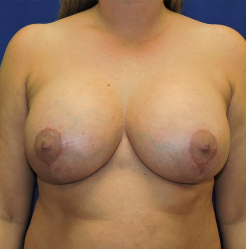 Breast Augmentation With Lift