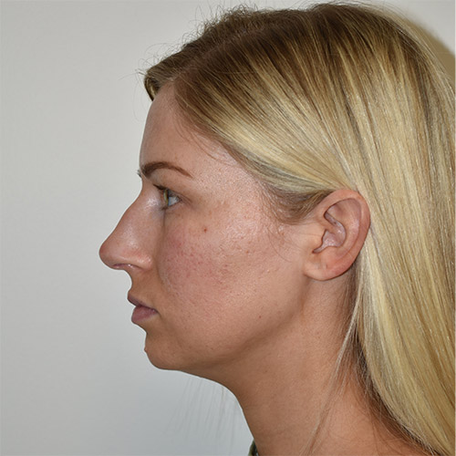 Rhinoplasty