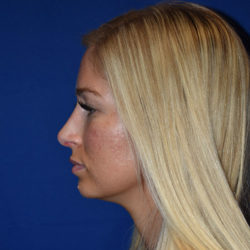 Rhinoplasty