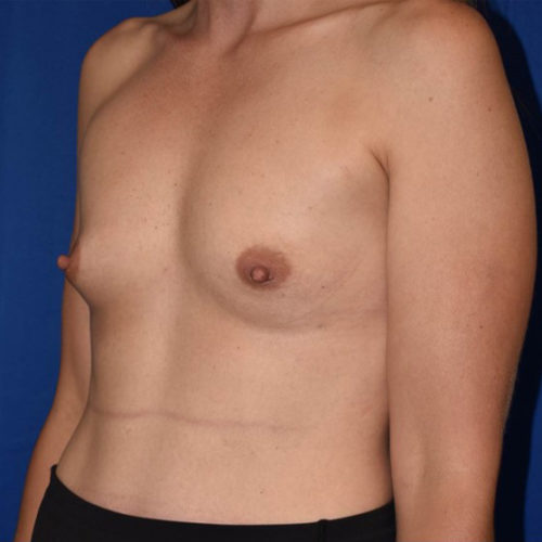 Breast Augmentation