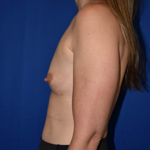 Breast Augmentation