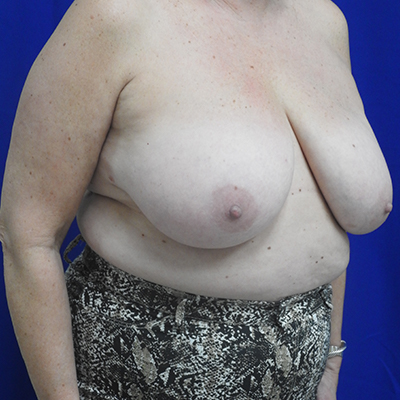 Breast Reduction