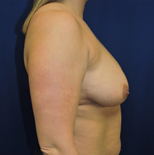 Breast Augmentation With Lift