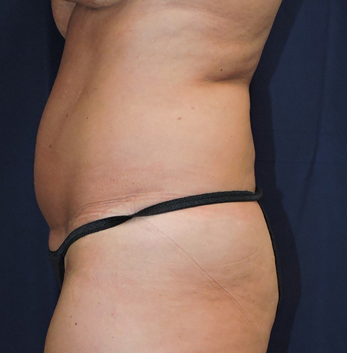 Liposuction