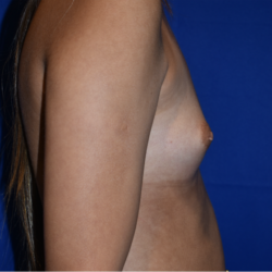 Breast Augmentation