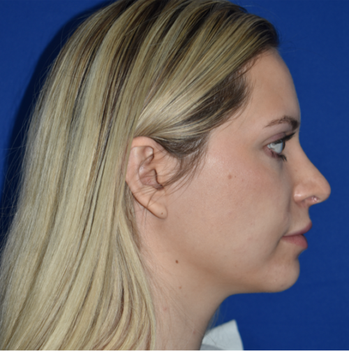 Rhinoplasty