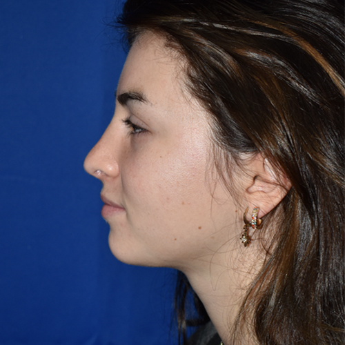 Rhinoplasty