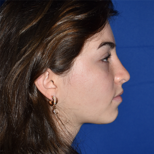 Rhinoplasty