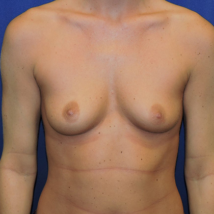 Breast Augmentation