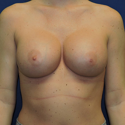 Breast Augmentation