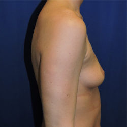 Breast Augmentation