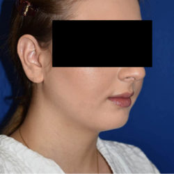 Chin Liposuction