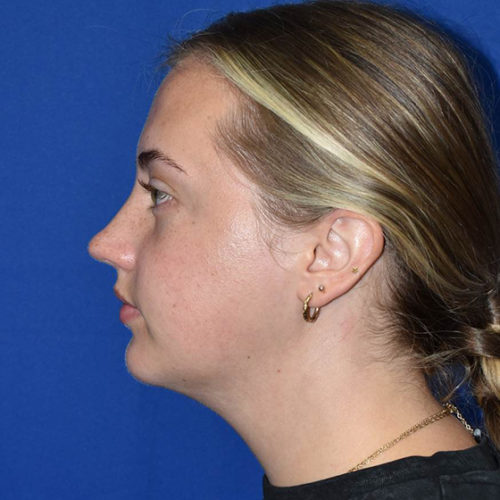 Chin Augmentation